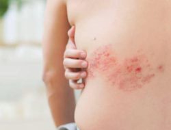 Apa Itu Herpes? Cari Tahu Penyebaran dan Pengobatan!