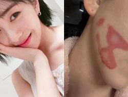 Kronologi Kwon Mina Eks AOA Alami Luka Bakar Saat Perawatan Wajah, Siap Ajukan Tuntutan Hukum