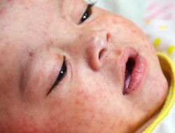 Mengapa Anak Kurang Gizi Rentan Terkena Komplikasi Campak?